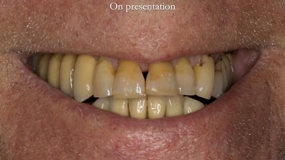 Ken – going downhill, first class