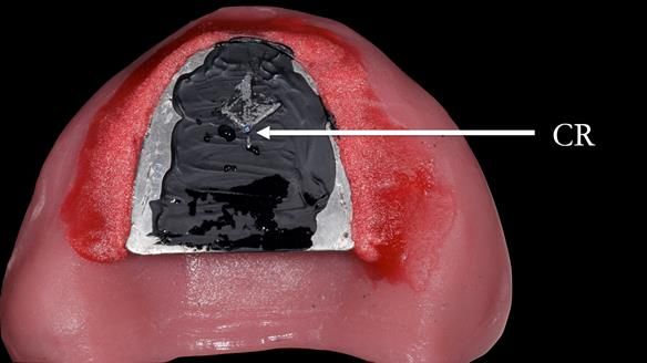 Newsletter 52 Managing Jo’s failing dentition with extractions and Mk 1/Mk 2 complete upper dentures and lower partial dentures FULL PROTOCOL