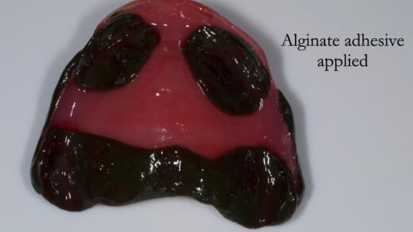 Managing poor implant positioning with complete dentures and Locator attachments - full protocol Newsletter 41