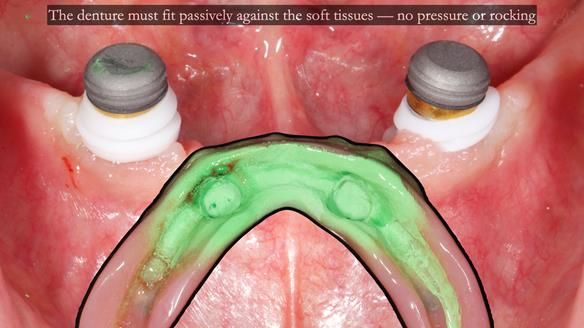 Newsletter 78: What do Clark Gable and a Locator® overdenture have in common?