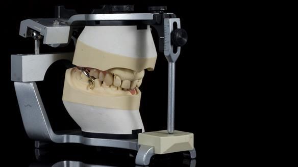 Newsletter 86 Peter the Architect — precision removable partial dentures case study