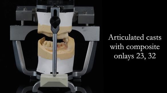 Newsletter 55 Provision of metal based partial dentures for Zephyrine with a repaired cleft lip and palate