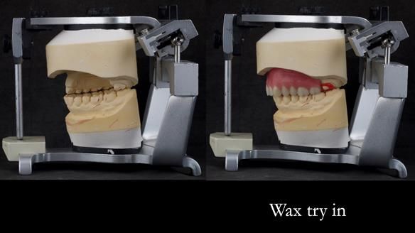 Upper metal base partial denture/occlusal stabilisation splint/obturator - full protocol