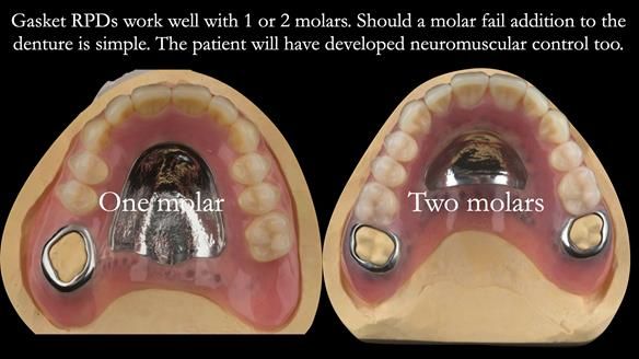 Finlay's Newsletter 58 Gasket upper partial denture for Zoe