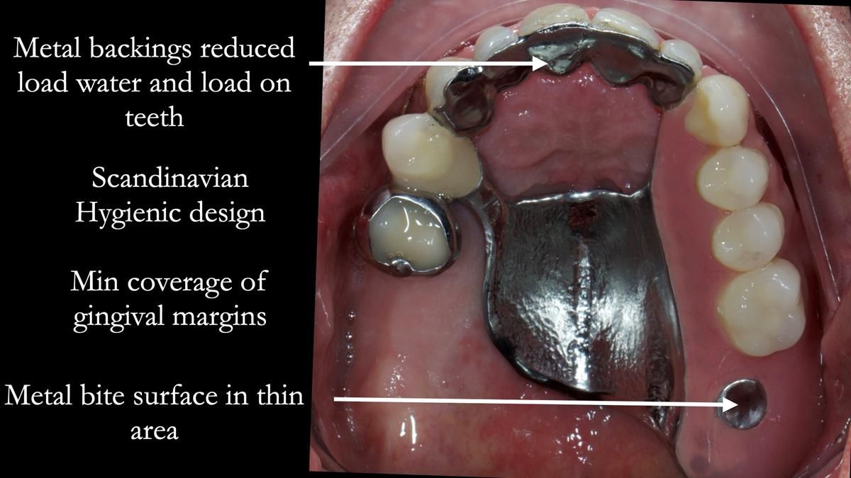 Newsletter 89 – Simon: A Challenging Kennedy Class II Division 1 Upper CoCr Partial Denture with a High Smile Line