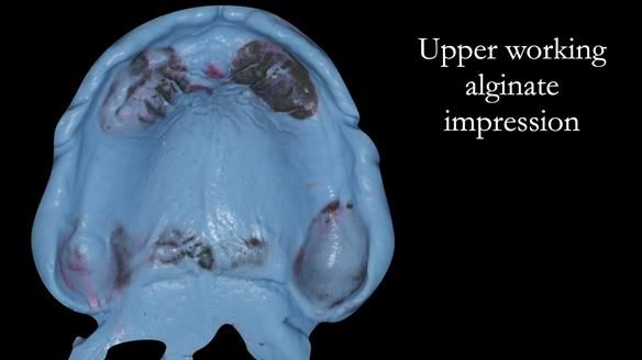 Complete denture Class II div 2 deep overbite Newsletter 39