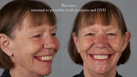 Newsletter 76: Jackie’s case – Telescopic overdenture & precision RPD (the tricky truth!)