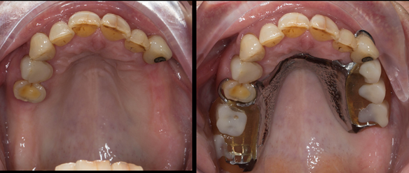 Figure 4 The remaining natural upper 8 teeth reduced but healthy periodontal attachment. Upper denture with suboptimal extensions.