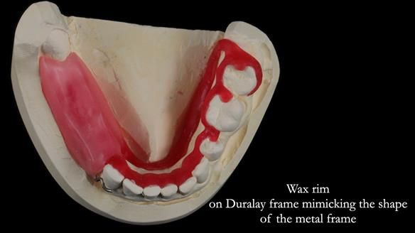 Finlay's Newsletter 61 provision of a lower unilateral free end saddle metal based partial denture for Joyce