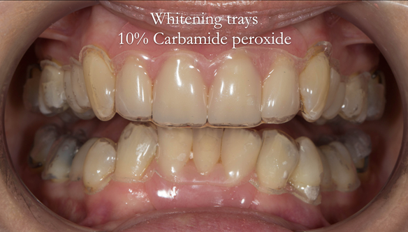 Figure 52 tooth-whitening trays made to fit over natural teeth and dentures