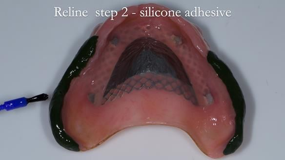 Newsletter 54 case presentation upper complete denture and lower Scandinavian designed hygienic partial denture for David