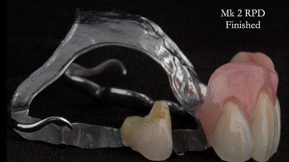Finlay's Newsletter 63 Case study provision of metal based Scandinavian RPD - functional 10 years on