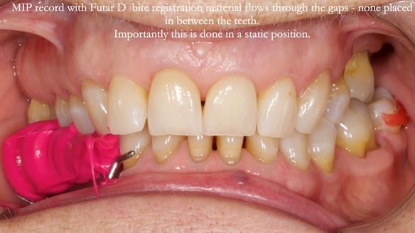 Finlay's Newsletter 61 provision of a lower unilateral free end saddle metal based partial denture for Joyce