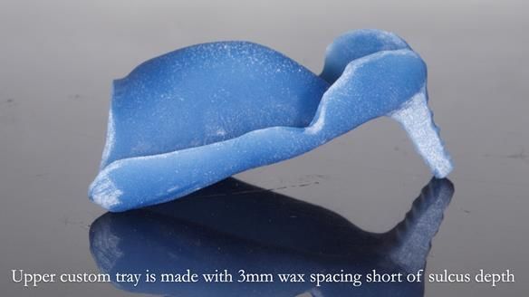 Newsletter 77: Jeremy’s case – immediate complete upper denture