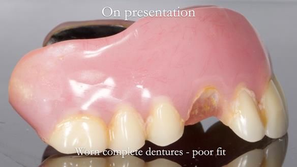 Newsletter 57 showcases the making and fitting process of implant-supported complete dentures for Alisdair
