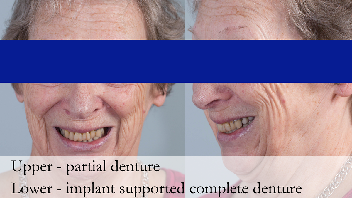 Figure 1 Pre - treatment. High smile line showing metal clasp.
