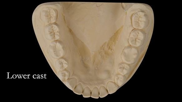Upper metal base partial denture/occlusal stabilisation splint/obturator - full protocol