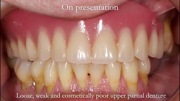 Finlay's Newsletter 58 Gasket upper partial denture for Zoe