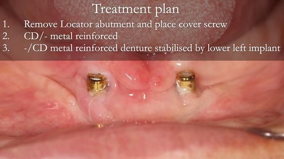 Managing poor implant positioning with complete dentures and Locator attachments - full protocol Newsletter 41