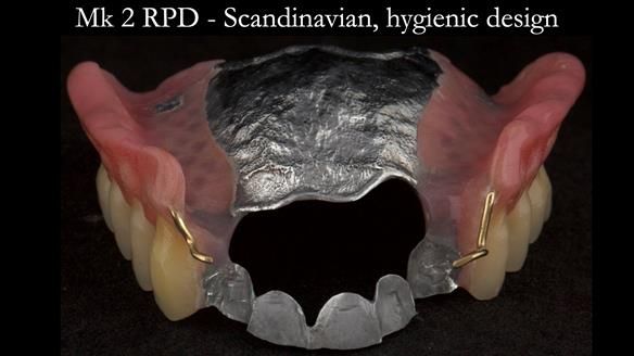 Finlay's Case Study Newsletter 40 - Immediate Mk 1 RPD to Definitive Mk 2 RPD - full protocol