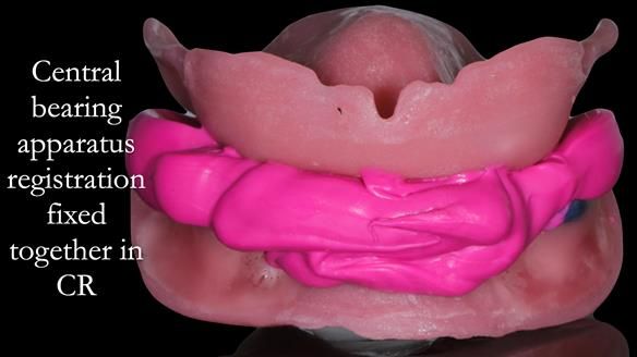 Newsletter 50 Special edition Complete Dentures FULL PROTOCOL