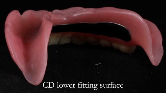 Finlay's Newsletter 62 provision of extractions and metal based complete dentures for Rafique