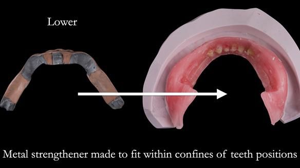 Newsletter 50 Special edition Complete Dentures FULL PROTOCOL