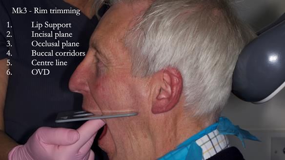 Newsletter 77: Jeremy’s case – immediate complete upper denture