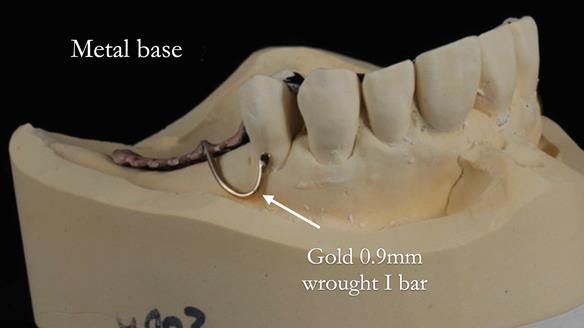 Newsletter 56 showing the making and fitting of a bilateral free end saddle upper removable partial denture (RPD) for patient with pemphigus