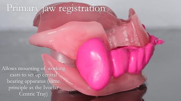 Finlay's Newsletter 59 Ultra hard partial dentures made for Gill