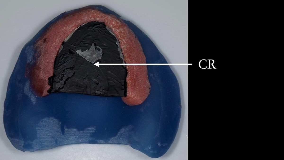 Fin’s Newsletter 88 — Complete dentures - full protocol… he rearranged his own teeth!