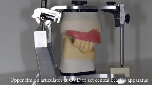 Newsletter 77: Jeremy’s case – immediate complete upper denture