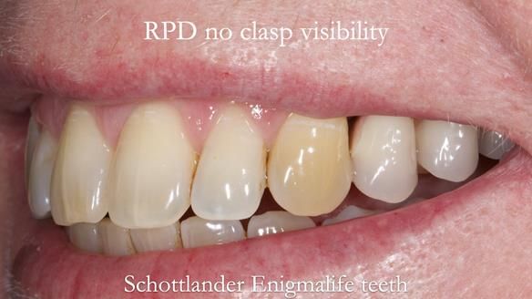 Solving Sue's failed implants with metal based RPD - full protocol Newsletter 43