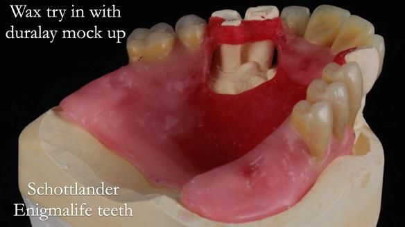 Finlay's Newsletter 59 Ultra hard partial dentures made for Gill