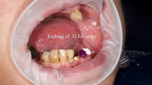 Newsletter 55 Provision of metal based partial dentures for Zephyrine with a repaired cleft lip and palate