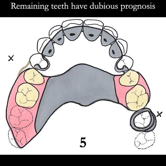 Universal Scandinavian partial denture designs