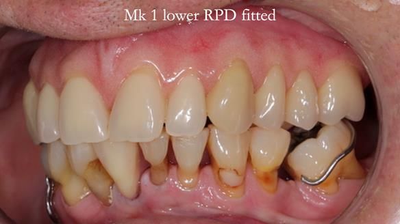 Newsletter 54 case presentation upper complete denture and lower Scandinavian designed hygienic partial denture for David