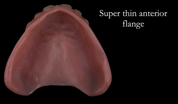 Figure 99 Mk 2 definitive denture finished - with super thin flange under the base of the nose for optimal lip support