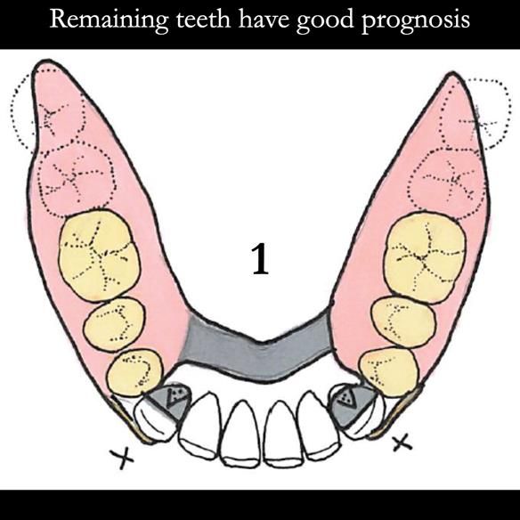 Universal Scandinavian partial denture designs