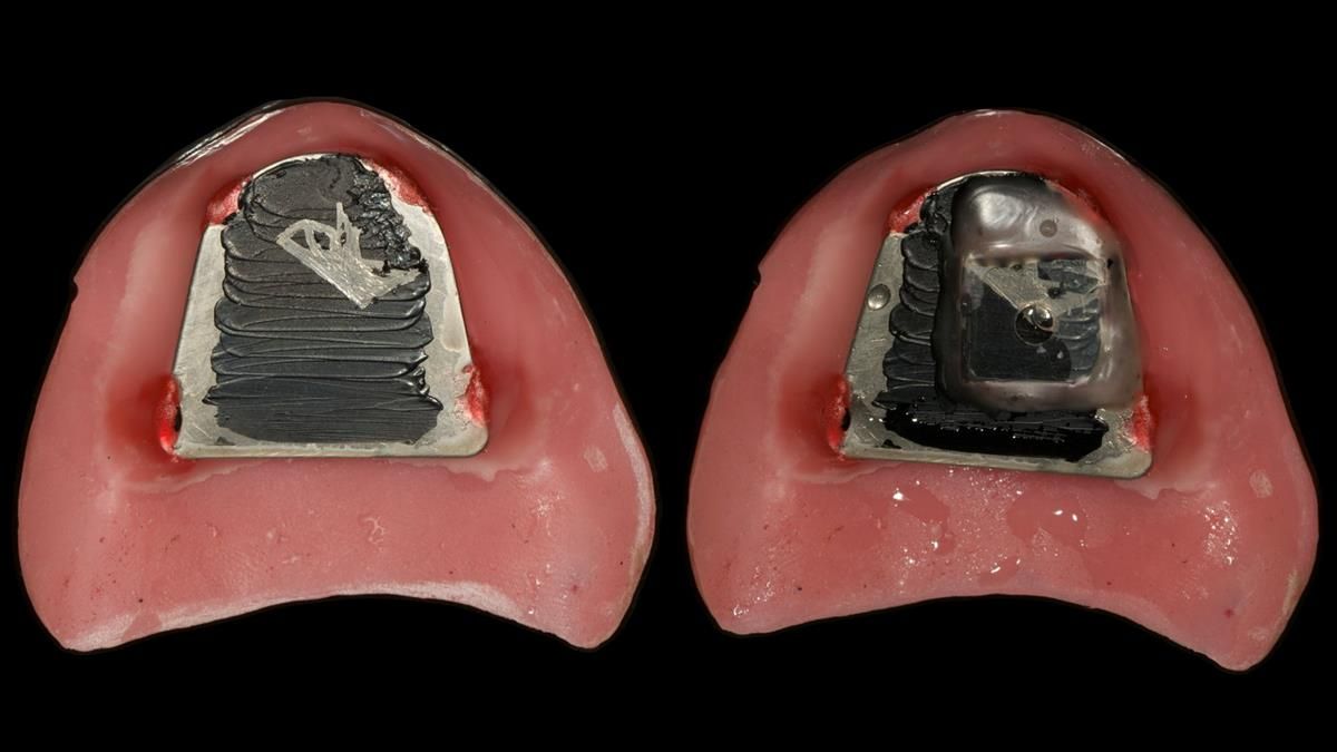 Newsletter 87 – Father Peter: A Partial Denture that needed Minor Miracle