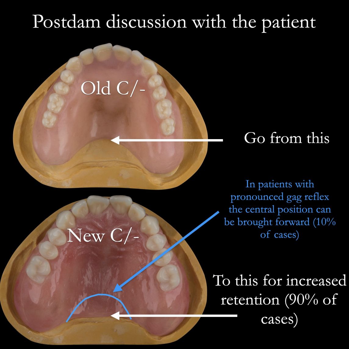Post dam discussion – it may be further back in the upper complete denture