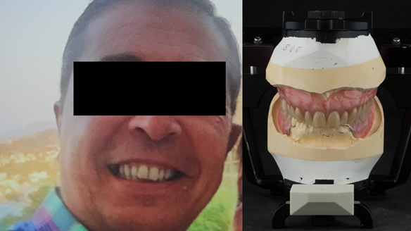 Figure 31 Finished denture mimicking the natural teeth