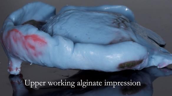 Complete denture Class II div 2 deep overbite Newsletter 39