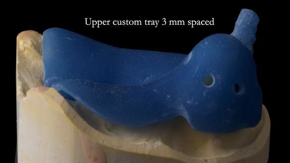 Newsletter 55 Provision of metal based partial dentures for Zephyrine with a repaired cleft lip and palate