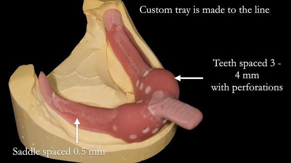 Newsletter 52 Managing Jo’s failing dentition with extractions and Mk 1/Mk 2 complete upper dentures and lower partial dentures FULL PROTOCOL