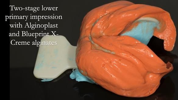 Newsletter 75: Marion’s case - Step-by-step complete denture workflow