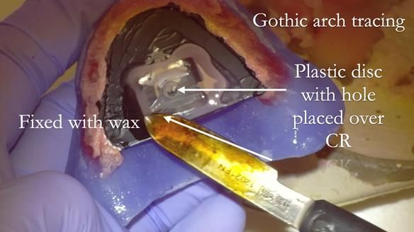 Newsletter 78: What do Clark Gable and a Locator® overdenture have in common?