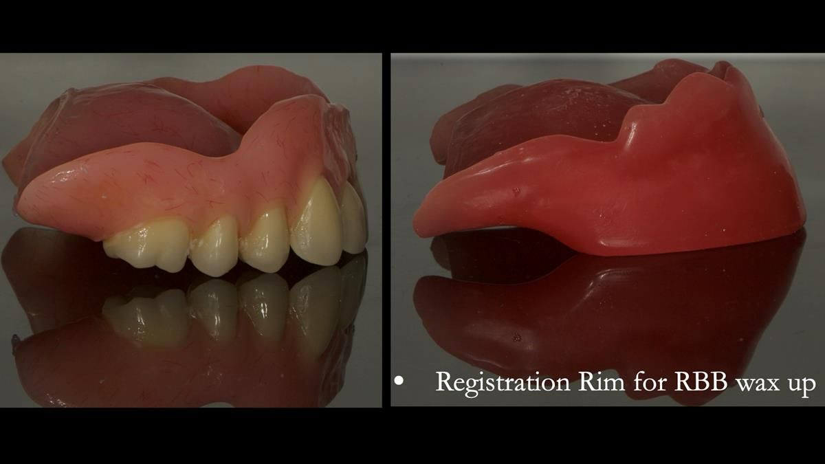 Newsletter 87 – Father Peter: A Partial Denture that needed Minor Miracle