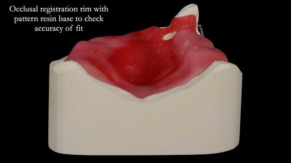 Newsletter 55 Provision of metal based partial dentures for Zephyrine with a repaired cleft lip and palate