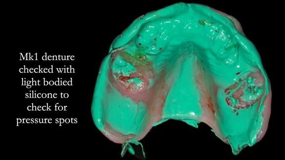 Newsletter 77: Jeremy’s case – immediate complete upper denture